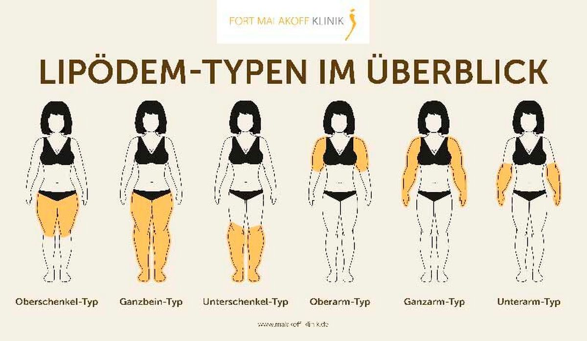 Grafik: Lipödem-Typen