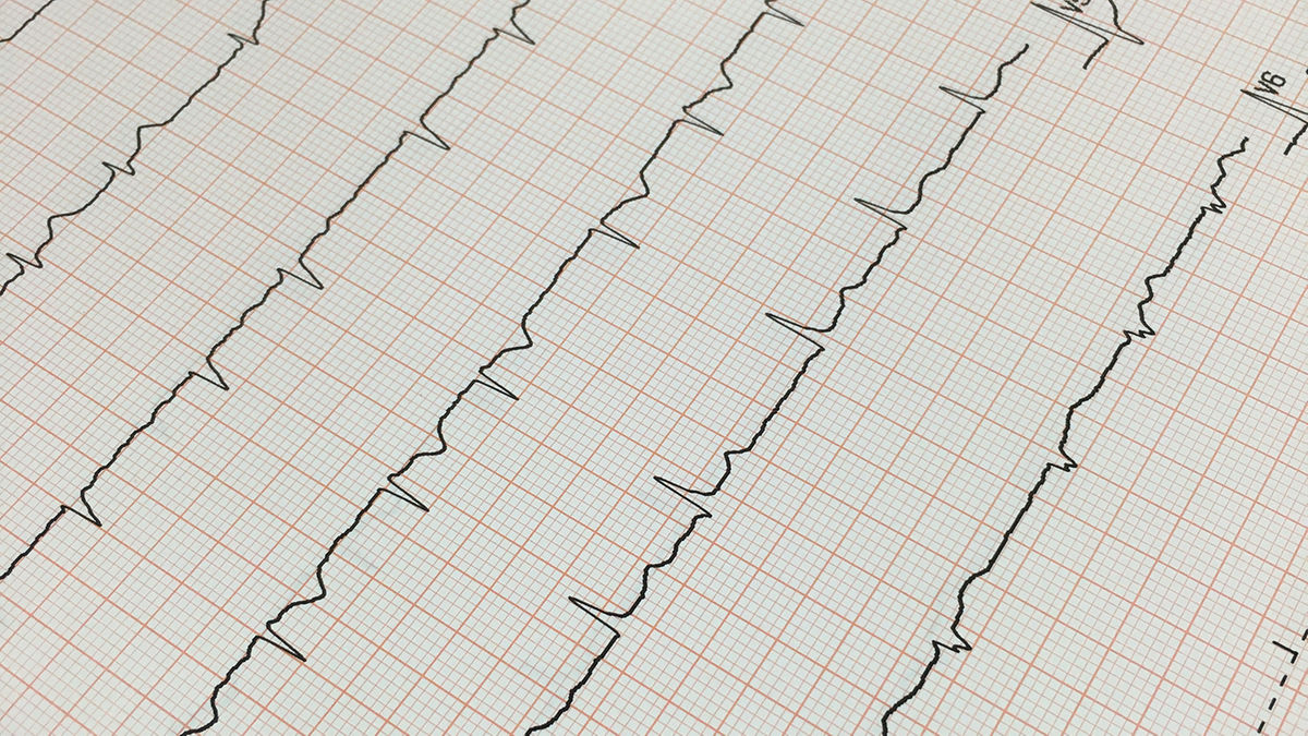 Vorhofflimmern - So honoriert der EBM die Diagnostik